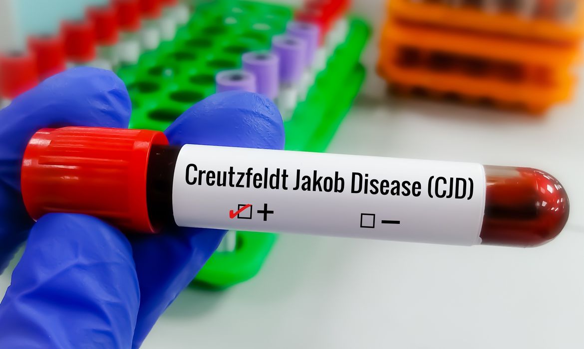 Diagnóstico da Creutzfeldt-Jakob: como funciona